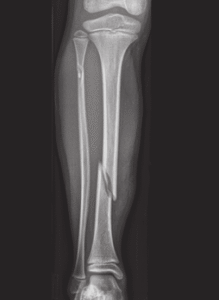 Fratura da Perna