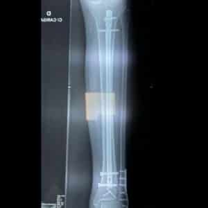 Tratamento Fratura Perna