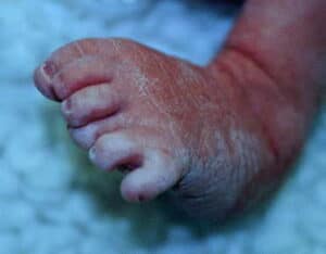Polidactilia Pós Axial