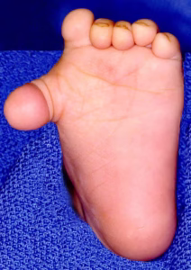 Polidactilia Pré Axial