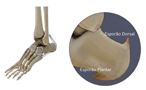 Esporão Calcaneo